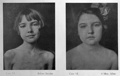 Mädchen vor und nach Insulinbehandlung Quelle Wellcome Collection