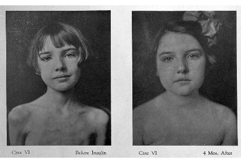 Mädchen vor und nach Insulinbehandlung_470x319